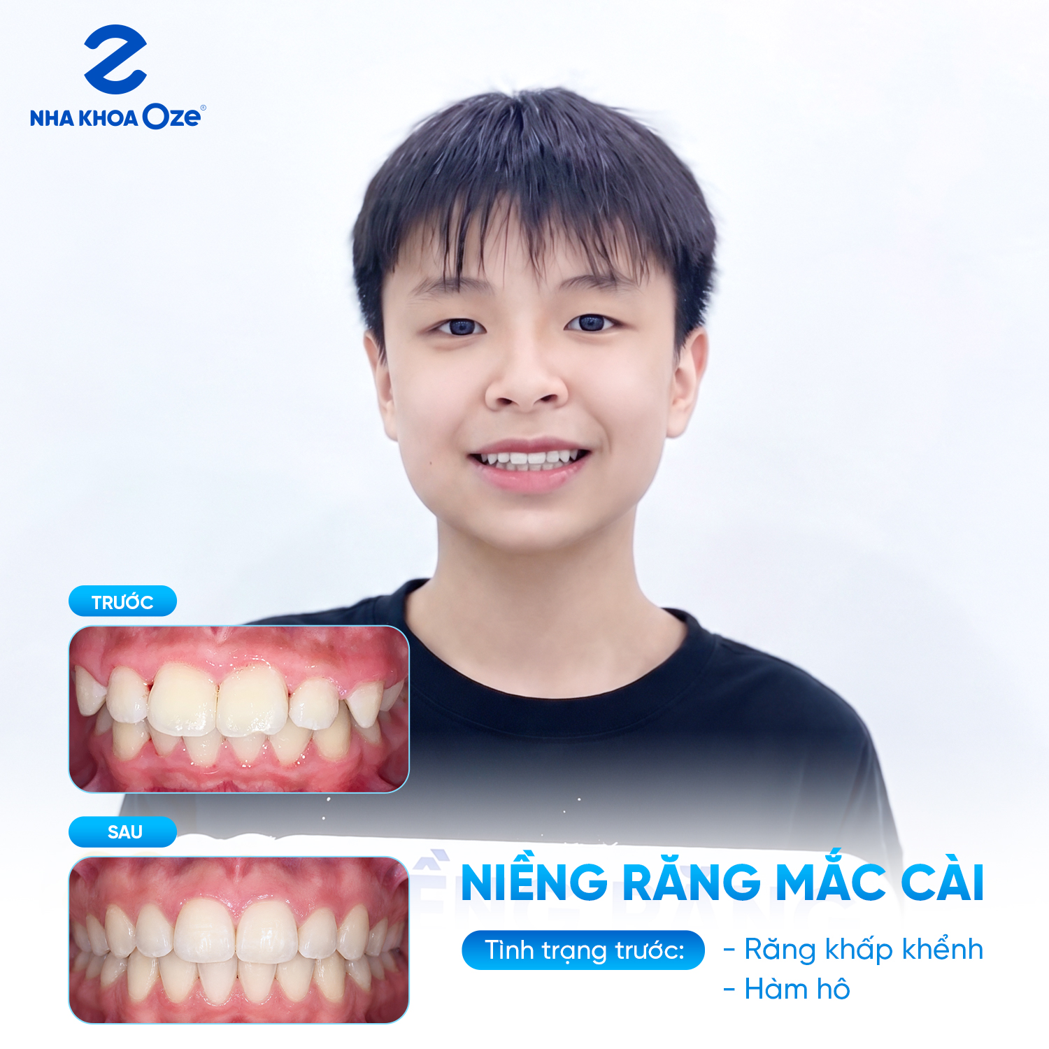 Sự khác biệt trước - sau khi niềng răng khấp khểnh tại Sóc Sơn