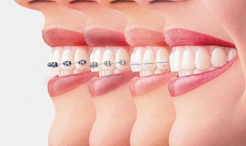 Các phương pháp niềng răng chỉnh khớp cắn phù hợp