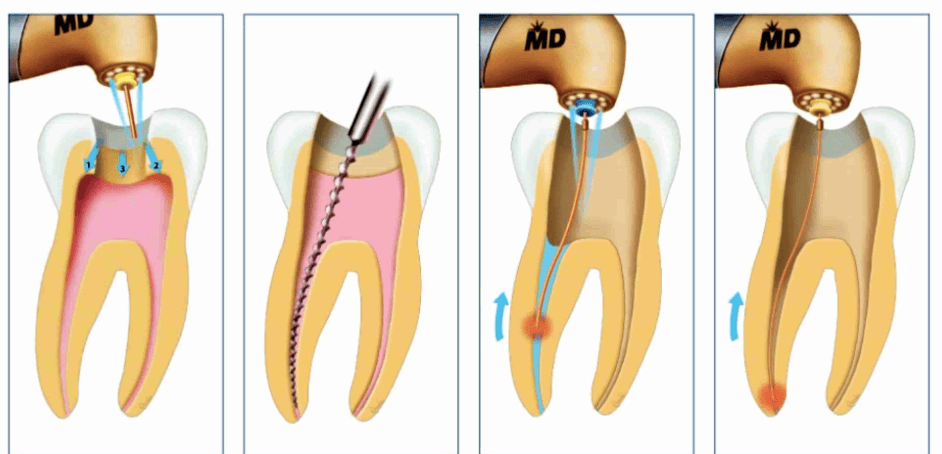 Dấu hiệu răng sâu đến tủy gây đau nhức