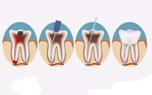 Chữa tủy răng hàm dưới tại Sóc Sơn – Công nghệ siêu âm không đau