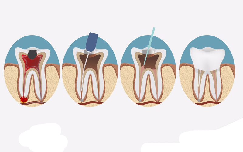 Chữa tủy răng hàm dưới tại Sóc Sơn – Công nghệ siêu âm không đau