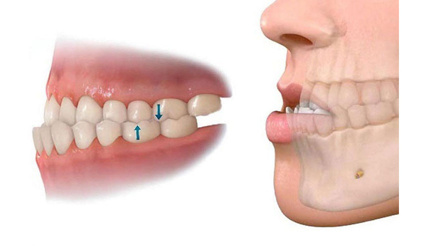 Niềng răng lệch khớp cắn tại Sóc Sơn cho răng móm