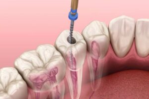Điều trị tủy răng sâu tại Sóc Sơn – Cứu răng thật, không còn đau nhức Điều trị tủy răng sâu tại Sóc Sơn thường được cân nhắc khi lỗ sâu đã tiến triển vào bên trong răng, gây viêm hoặc nhiễm khuẩn tủy. Nếu được xử lý đúng thời điểm, răng thật vẫn có cơ hội được bảo tồn thay vì phải nhổ bỏ. Tại Nha khoa Oze, bác sĩ sẽ kiểm tra tình trạng răng, đánh giá mức độ tổn thương và chụp phim khi cần thiết trước khi tư vấn phương án điều trị phù hợp. Khi nào cần điều trị tủy răng sâu tại Sóc Sơn? Không phải chiếc răng sâu nào cũng cần chữa tủy. Nếu tổn thương còn nông, bác sĩ có thể làm sạch phần sâu và phục hồi răng bằng phương pháp phù hợp. Tuy nhiên, khi vi khuẩn đã ảnh hưởng đến mô tủy nằm bên trong răng, việc chỉ trám kín bề mặt thường không đủ để xử lý nguyên nhân gây đau. Bác sĩ có thể cân nhắc điều trị tủy khi: Lỗ sâu đã lan gần hoặc vào buồng tủy. Răng đau kéo dài, đặc biệt khi ăn nhai. Cảm giác ê buốt với thức ăn nóng hoặc lạnh không hết ngay sau khi ngừng kích thích. Lợi quanh chân răng sưng đau hoặc xuất hiện nốt bất thường. Răng bị nứt, vỡ hoặc chấn thương làm ảnh hưởng đến tủy. Phim chụp cho thấy vùng quanh chân răng có dấu hiệu cần được theo dõi và xử lý. Có trường hợp răng đau dữ dội, nhưng cũng có trường hợp tổn thương tiến triển mà biểu hiện không rõ ràng. Vì vậy, khách hàng không nên chờ đến khi đau nhiều mới đi khám. Dấu hiệu răng sâu đến tủy không nên bỏ qua Sâu răng thường tiến triển âm thầm. Ban đầu, người bệnh có thể chỉ cảm thấy hơi ê khi ăn đồ ngọt hoặc uống nước lạnh. Khi tổn thương lan sâu hơn, các biểu hiện có thể rõ rệt hơn. Đau nhức tự nhiên hoặc đau tăng vào ban đêm Cơn đau có thể xuất hiện ngay cả khi không ăn uống. Một số người cảm thấy đau âm ỉ kéo dài; một số khác đau thành từng cơn, ảnh hưởng đến giấc ngủ. Ê buốt kéo dài khi ăn nóng hoặc lạnh Nếu cảm giác ê vẫn còn sau khi đã ngừng ăn uống, khách hàng nên sắp xếp thời gian đi khám. Đây có thể là dấu hiệu mô tủy đang bị kích thích hoặc tổn thương. Đau khi cắn hoặc nhai thức ăn Răng đau khi cắn xuống cần được kiểm tra sớm. Nguyên nhân có thể liên quan đến sâu răng, viêm tủy, vùng quanh chóp hoặc một vấn đề khác mà mắt thường khó đánh giá chính xác. Lợi sưng hoặc xuất hiện nốt nhỏ gần chân răng Nốt bất thường trên lợi, sưng đau tái diễn hoặc cảm giác có dịch chảy ra quanh chân răng là dấu hiệu không nên chủ quan. Việc tự chọc hoặc nặn không giúp giải quyết nguyên nhân bên trong. Răng đổi màu hoặc vỡ lớn Một chiếc răng sẫm màu hơn các răng xung quanh, đặc biệt sau chấn thương, cần được bác sĩ kiểm tra. Với răng sâu lớn, thức ăn thường xuyên mắc lại hoặc thân răng vỡ nhiều, khả năng ảnh hưởng đến tủy cũng cao hơn. Vì sao không nên chỉ uống thuốc giảm đau? Thuốc giảm đau có thể giúp người bệnh dễ chịu hơn trong thời gian ngắn, nhưng không loại bỏ phần mô tủy đã viêm hoặc nhiễm khuẩn. Khi nguyên nhân chưa được xử lý, cơn đau có thể quay trở lại. Nếu trì hoãn quá lâu, tổn thương có thể lan rộng hơn, gây sưng lợi, áp xe hoặc ảnh hưởng đến mô quanh chân răng. Khi thân răng bị phá hủy nhiều, việc phục hồi cũng trở nên phức tạp hơn. Vì vậy, khi có dấu hiệu bất thường, khách hàng nên thăm khám sớm để biết răng chỉ cần trám phục hồi hay đã cần chữa tủy răng sâu. Điều trị tủy răng cối có gì khác biệt? Răng cối nằm phía trong, đảm nhiệm phần lớn lực nghiền thức ăn. So với răng cửa, răng cối thường có hệ thống ống tủy phức tạp hơn và khó quan sát hơn bằng mắt thường. Khi điều trị tủy răng cối, bác sĩ cần kiểm tra kỹ: Mức độ sâu và phần mô răng còn lại. Số lượng, hình dạng và vị trí ống tủy. Tình trạng vùng quanh chân răng. Khả năng phục hồi sau điều trị. Sau khi chữa tủy, một số răng cối mất nhiều mô cứng có thể cần thêm phương án bảo vệ phù hợp để hỗ trợ ăn nhai lâu dài. Bác sĩ sẽ tư vấn dựa trên tình trạng thực tế thay vì áp dụng cùng một cách cho tất cả các trường hợp. Quy trình điều trị tủy răng sâu tại Sóc Sơn ở Nha khoa Oze Mỗi chiếc răng có đặc điểm khác nhau, nhưng quy trình cơ bản thường gồm các bước sau: Bước 1: Khám và đánh giá tình trạng răng Bác sĩ kiểm tra lỗ sâu, mức độ đau, tình trạng lợi và phần mô răng còn lại. Phim chụp có thể được chỉ định để đánh giá chân răng, vùng quanh chóp và hướng điều trị. Bước 2: Kiểm soát cảm giác khó chịu Trước khi thực hiện, bác sĩ trao đổi về tình trạng sức khỏe, tiền sử dị ứng và thuốc đang sử dụng. Gây tê được thực hiện khi phù hợp để khách hàng cảm thấy dễ chịu hơn trong quá trình xử lý. Bước 3: Làm sạch mô tủy bị tổn thương Bác sĩ tạo đường tiếp cận vào buồng tủy, loại bỏ phần mô viêm hoặc nhiễm khuẩn và xử lý hệ thống ống tủy. Bước 4: Tạo hình và hàn kín ống tủy Sau khi được làm sạch, ống tủy được tạo hình và hàn kín nhằm hạn chế nguy cơ vi khuẩn tiếp tục xâm nhập. Bước 5: Phục hồi thân răng Tùy vào mức độ mất mô răng, bác sĩ sẽ tư vấn trám phục hồi hoặc giải pháp bảo vệ răng phù hợp. Đây là bước quan trọng vì răng vẫn cần chịu lực khi ăn nhai hằng ngày. Bước 6: Tái khám khi cần thiết Sau điều trị, khách hàng nên theo dõi tình trạng răng và tái khám theo lịch hẹn. Nếu đau tăng dần, sưng hoặc xuất hiện dấu hiệu bất thường, cần liên hệ bác sĩ để được kiểm tra. Điều trị tủy có đau không? Nhiều khách hàng trì hoãn đi khám vì lo lắng chữa tủy sẽ gây đau. Trên thực tế, bác sĩ có thể sử dụng gây tê phù hợp để kiểm soát cảm giác khó chịu trong quá trình điều trị. Cụm từ điều trị tủy không đau không nên được hiểu là một lời cam kết tuyệt đối. Cảm nhận của mỗi người có thể khác nhau tùy vào vị trí răng, mức độ viêm và tình trạng thực tế. Mục tiêu của bác sĩ là giúp quá trình điều trị diễn ra nhẹ nhàng và an toàn hơn. Sau khi chữa tủy, răng có thể hơi nhạy cảm trong thời gian ngắn. Nếu cảm giác đau tăng lên thay vì giảm dần, khách hàng nên liên hệ với phòng khám để được kiểm tra. Chi phí điều trị tủy răng sâu tại Sóc Sơn Chi phí phụ thuộc vào vị trí răng, mức độ tổn thương, đặc điểm hệ thống ống tủy và phương án phục hồi sau điều trị. Dịch vụ Phù hợp với Chi phí tham khảo Điều trị tủy răng cửa Răng cửa sâu đến tủy hoặc tổn thương tủy Liên hệ tư vấn Điều trị tủy răng tiền cối Răng tiền cối có chỉ định chữa tủy Liên hệ tư vấn Điều trị tủy răng cối Răng cối sâu lớn, viêm hoặc nhiễm khuẩn tủy Liên hệ tư vấn Trám phục hồi sau chữa tủy Phục hồi phần thân răng sau điều trị Theo tình trạng thực tế Phục hồi bảo vệ răng Răng mất nhiều mô cứng, cần đánh giá khả năng chịu lực Theo chỉ định bác sĩ Thăm khám và chụp phim Kiểm tra tổn thương và vùng quanh chân răng Liên hệ phòng khám Bảng giá chính xác cần được xác định sau khi bác sĩ kiểm tra trực tiếp. Với điều trị tủy, khách hàng không nên chỉ so sánh chi phí mà bỏ qua mức độ tổn thương và kế hoạch phục hồi răng sau đó. Chăm sóc răng sau khi chữa tủy Để hạn chế cảm giác khó chịu và bảo vệ răng sau điều trị, khách hàng nên: Dùng thuốc theo đúng hướng dẫn của bác sĩ nếu được kê đơn. Tránh nhai đồ quá cứng tại vị trí vừa điều trị trong thời gian đầu. Vệ sinh răng miệng đều đặn nhưng nhẹ nhàng. Tái khám đúng lịch. Liên hệ phòng khám nếu đau tăng, sưng hoặc có biểu hiện bất thường. Răng đã chữa tủy vẫn cần được chăm sóc và kiểm tra định kỳ. Việc điều trị xong không có nghĩa là có thể bỏ qua vệ sinh răng miệng hằng ngày. Vì sao nên điều trị tủy răng sâu tại Nha khoa Oze? Nha khoa Oze tiếp nhận thăm khám các trường hợp sâu răng, đau nhức, ê buốt kéo dài và tổn thương tủy cần xử lý. Khi thực hiện điều trị tủy răng sâu tại Sóc Sơn, khách hàng được: Kiểm tra tình trạng răng trước khi điều trị. Chụp phim khi cần thiết để đánh giá mức độ tổn thương. Tư vấn hướng xử lý phù hợp với từng trường hợp. Theo dõi sau điều trị. Cân nhắc phương án phục hồi nhằm bảo tồn răng thật khi điều kiện cho phép. Với khách hàng ở Sóc Sơn và khu vực lân cận, việc lựa chọn địa chỉ thuận tiện cũng giúp chủ động hơn khi cần tái khám. Câu hỏi thường gặp Răng hết đau rồi có cần đi khám không? Có. Việc hết đau không đồng nghĩa với tổn thương đã tự khỏi. Một số trường hợp viêm hoặc nhiễm khuẩn vẫn có thể tiếp tục tiến triển bên trong răng. Chữa tủy xong răng có ăn nhai được không? Răng sau chữa tủy vẫn có thể thực hiện chức năng ăn nhai nếu được điều trị và phục hồi phù hợp. Với răng mất nhiều mô cứng, bác sĩ sẽ tư vấn thêm giải pháp bảo vệ cần thiết. Khi nào cần đi khám sớm? Khách hàng nên đi khám sớm nếu đau nhức kéo dài, lợi sưng, vùng mặt sưng, sốt hoặc khó há miệng. Nếu sưng lan nhanh kèm khó nuốt hoặc khó thở, cần tìm hỗ trợ y tế khẩn cấp. Khi nào nên đặt lịch khám? Bạn nên đặt lịch khám khi răng sâu lớn, đau nhức kéo dài, ê buốt với nóng lạnh, đau khi nhai hoặc xuất hiện dấu hiệu sưng quanh chân răng. Việc kiểm tra sớm giúp bác sĩ xác định tình trạng răng và tư vấn hướng xử lý phù hợp. Nếu bạn đang cần điều trị tủy răng sâu tại Sóc Sơn, hãy đặt lịch tại Nha khoa Oze để được bác sĩ thăm khám, chụp phim khi cần thiết và tư vấn phương án bảo tồn răng thật.