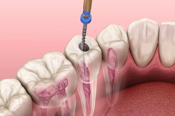 Điều trị tủy răng sâu tại Sóc Sơn – Cứu răng thật, không còn đau nhức