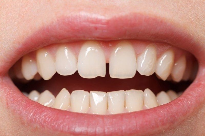 Tình trạng răng cửa thưa và khoảng cách giữa răng