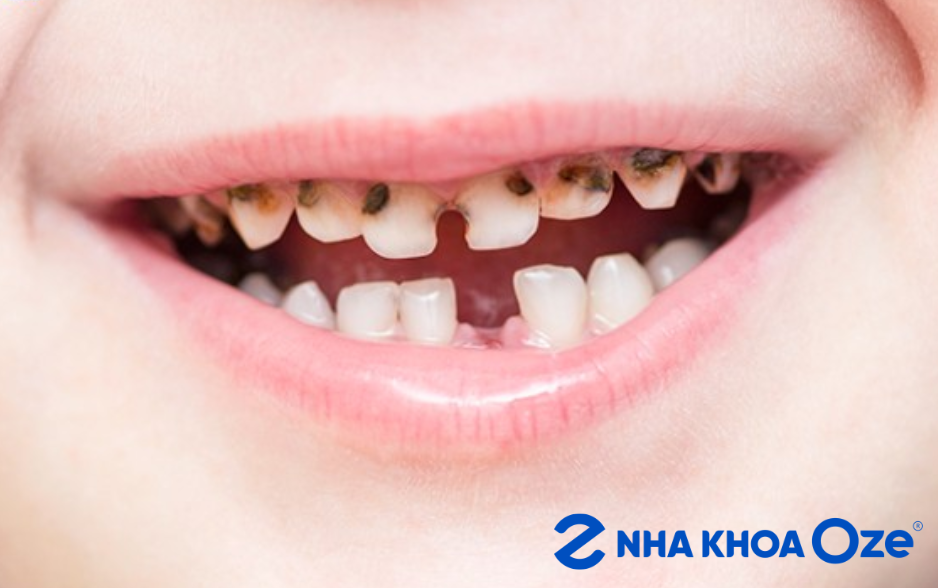 Dấu hiệu điều trị tủy răng sữa cho trẻ Sóc Sơn