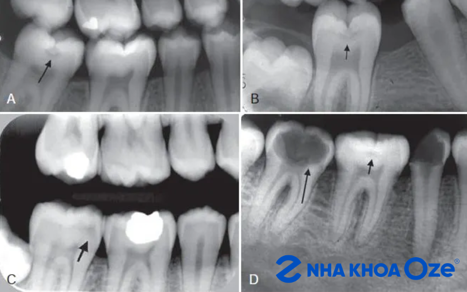 chụp X-quang chẩn đoán viêm tủy răng