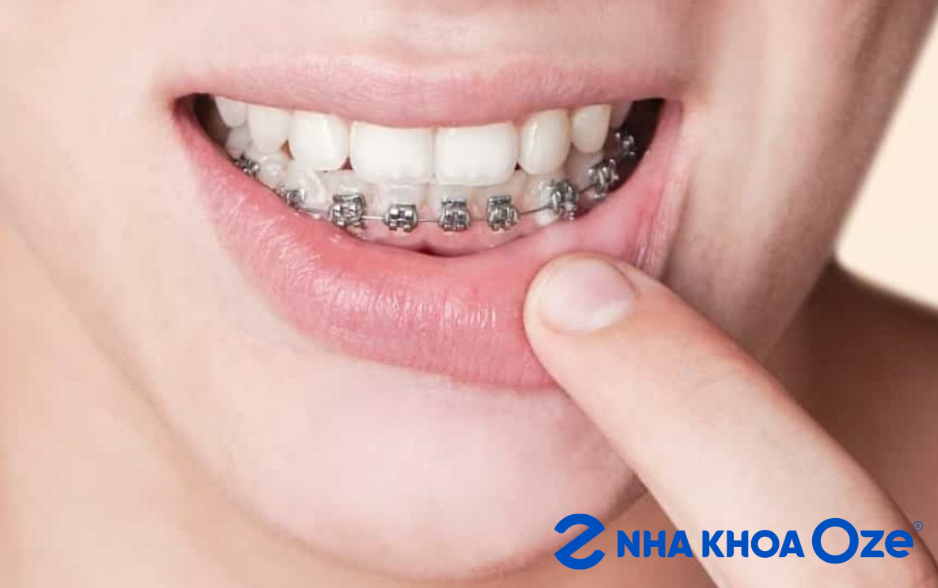 niềng răng 1 hàm Sóc Sơn