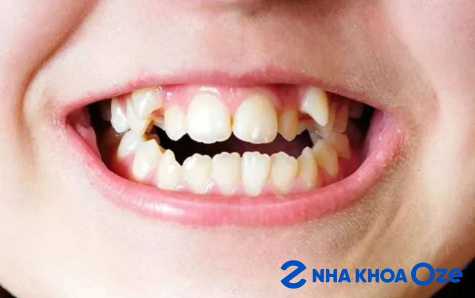 khi nào không nên niềng răng 1 hàm