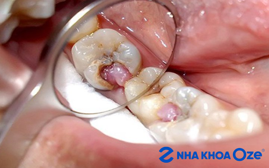 răng sâu lộ tủy và viêm tủy tiến triển