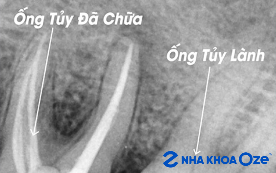 phim chụp giúp chẩn đoán viêm tủy răng chính xác hơn