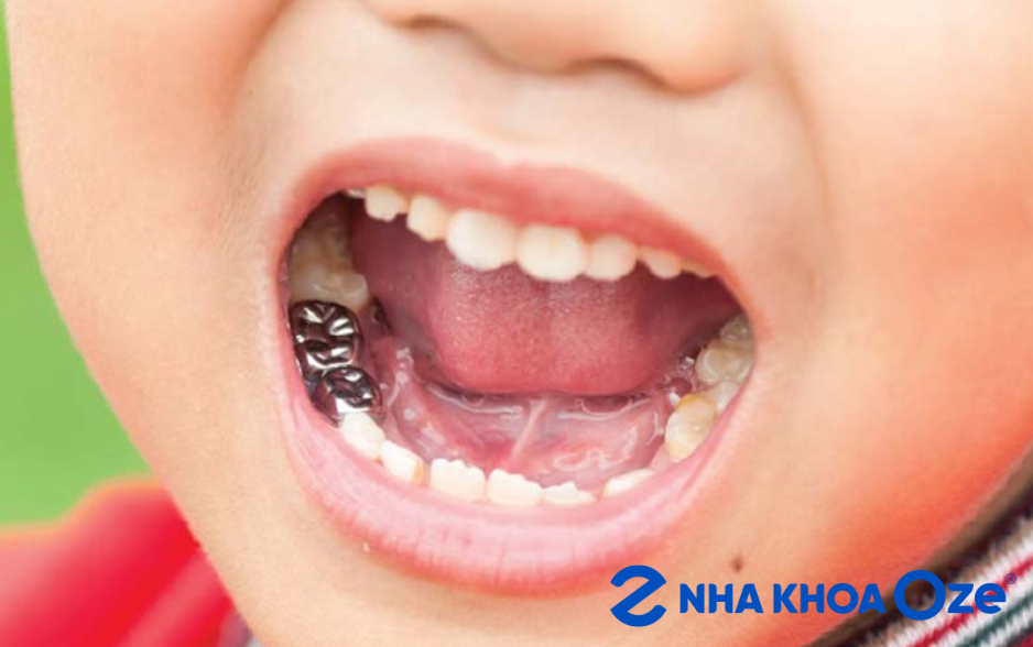 phục hồi hình thể răng sữa sau điều trị tủy cho trẻ
