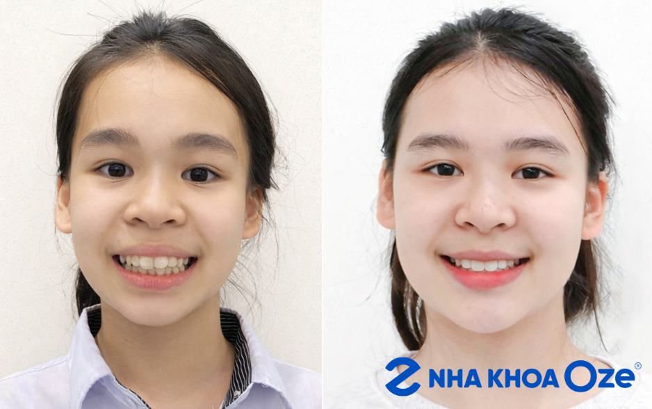 niềng răng hô nhẹ tại Sóc Sơn