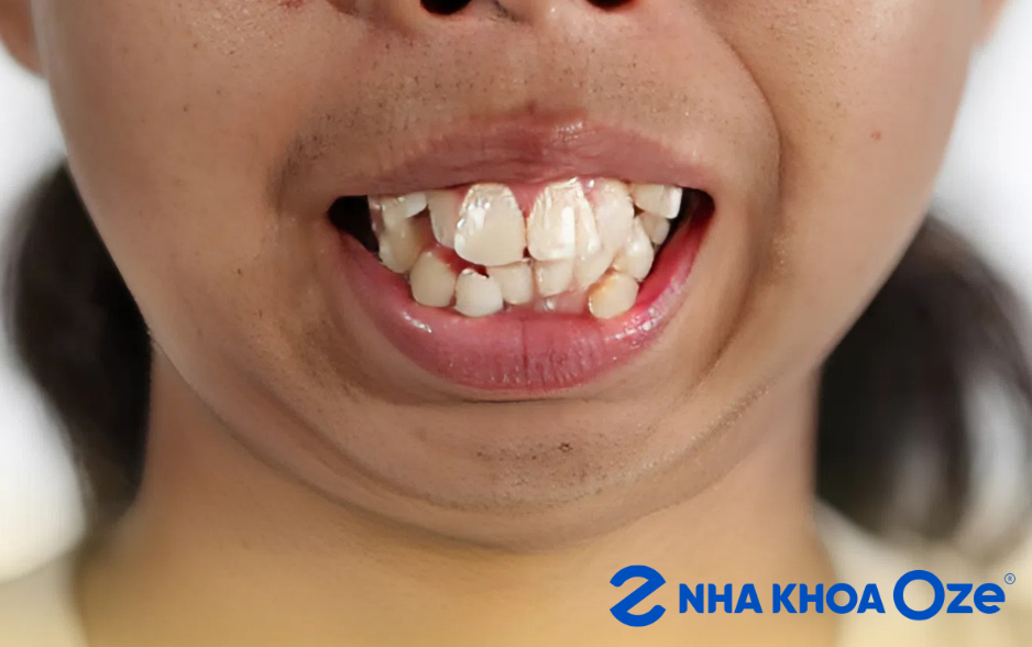 trường hợp răng hô nhẹ cần cân nhắc nhổ răng