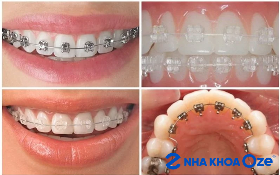 các loại mắc cài niềng răng hô nhẹ tại Sóc Sơn