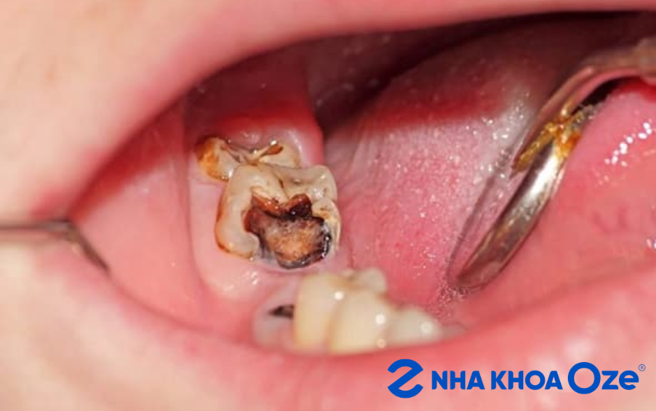 triệu chứng viêm tủy răng