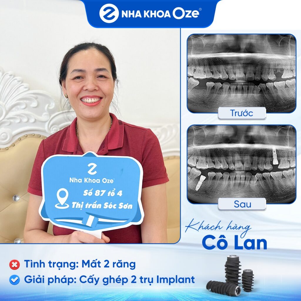 Feedback Implant 1