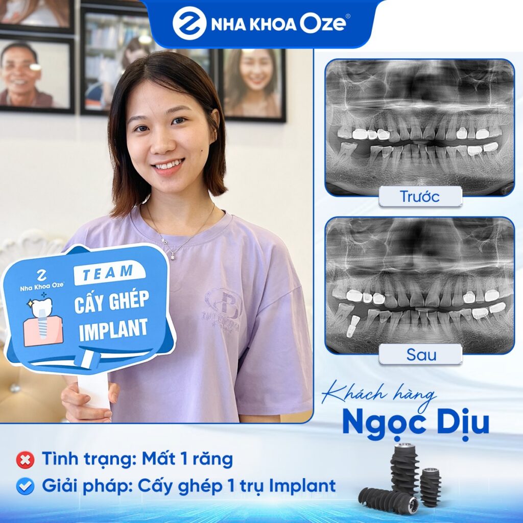 Feedback Implant 3