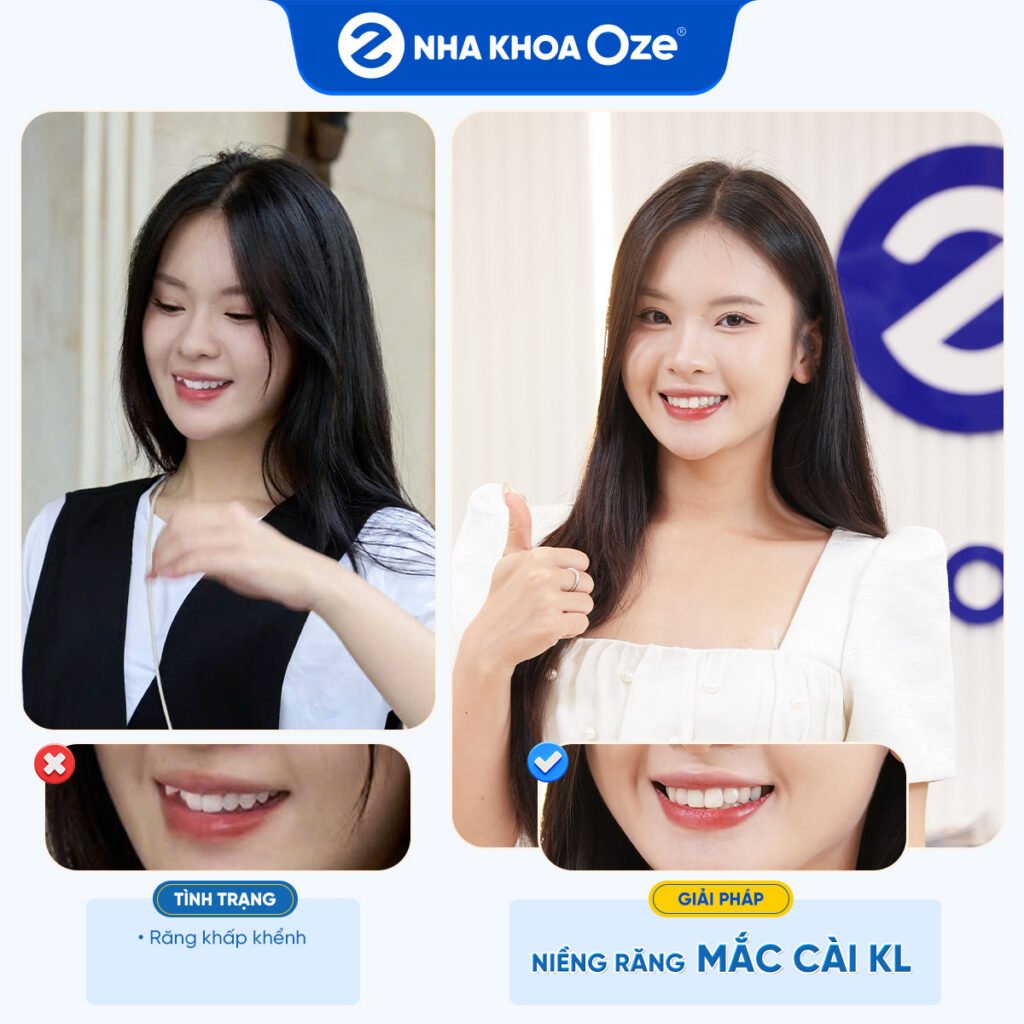 Feedback Niềng Răng 1