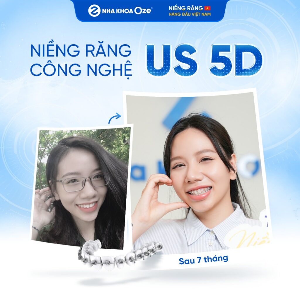 Feedback Niềng Răng 3