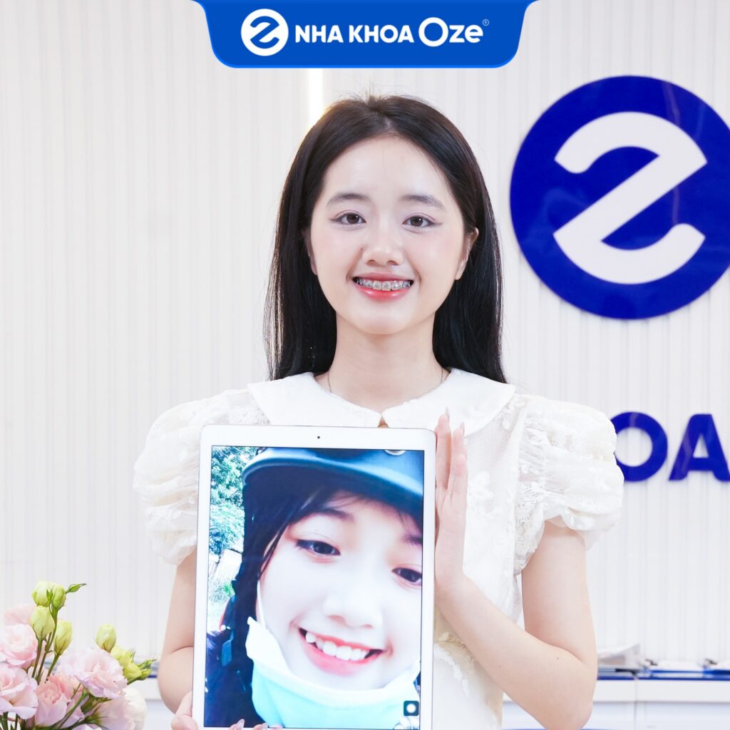 Feedback Niềng Răng 4