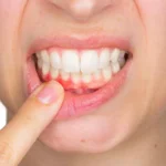 Tôi có bé bị sâu răng hàm phải làm sao? Nguyên nhân, tác hại và cách điều trị hiệu quả