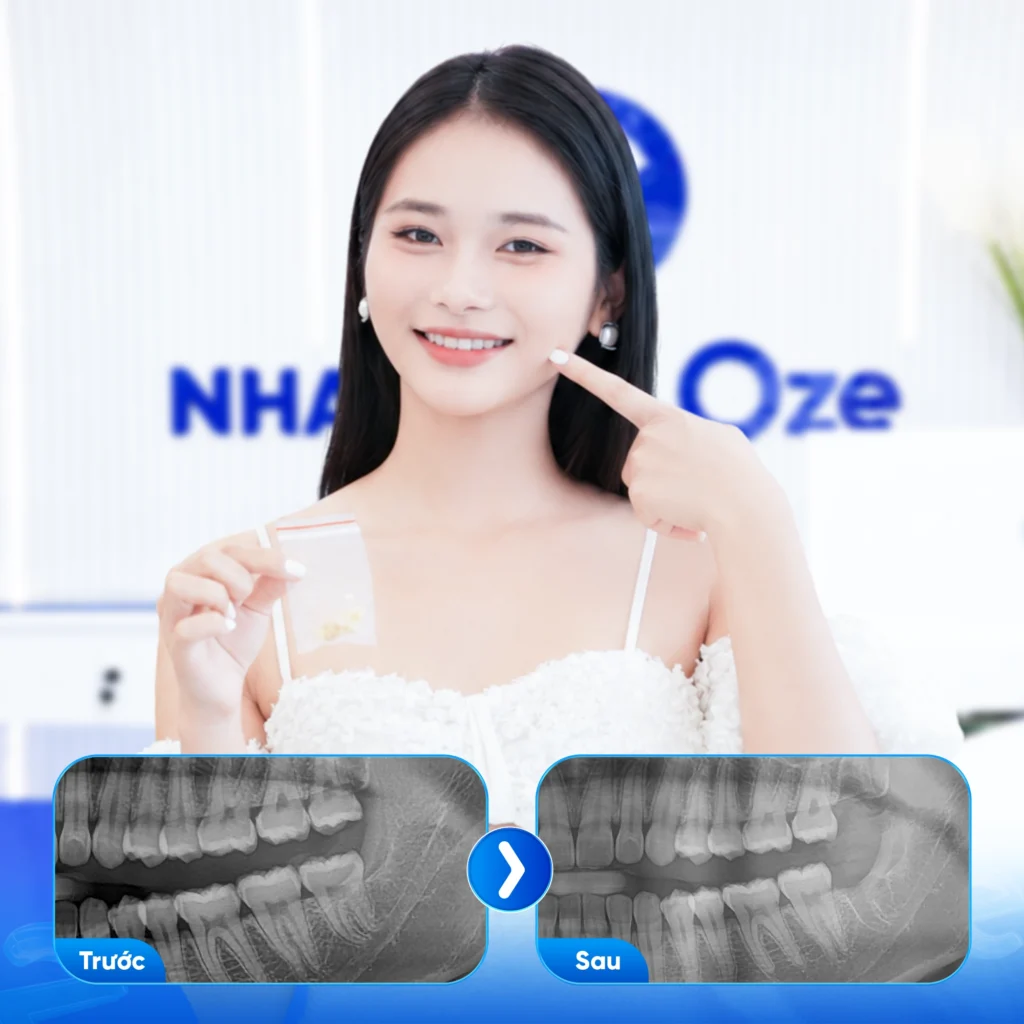 Feedback Nhổ Răng Khôn 3