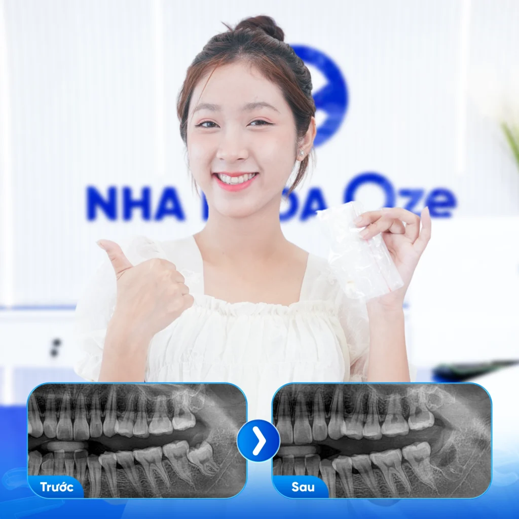 Feedback Nhổ Răng Khôn 2
