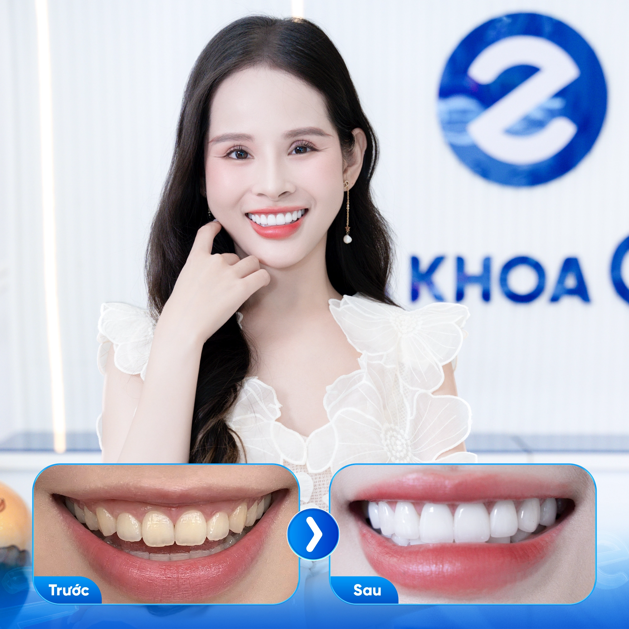 Khách hàng bọc răng sứ