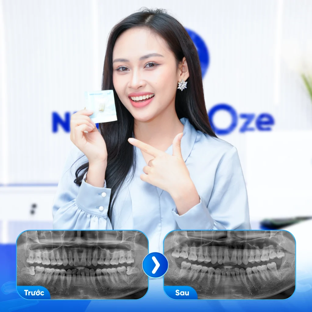Feedback Nhổ Răng Khôn 4