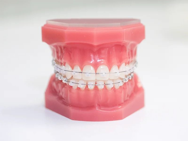 Ưu điểm vượt trội của niềng răng mắc cài sứ