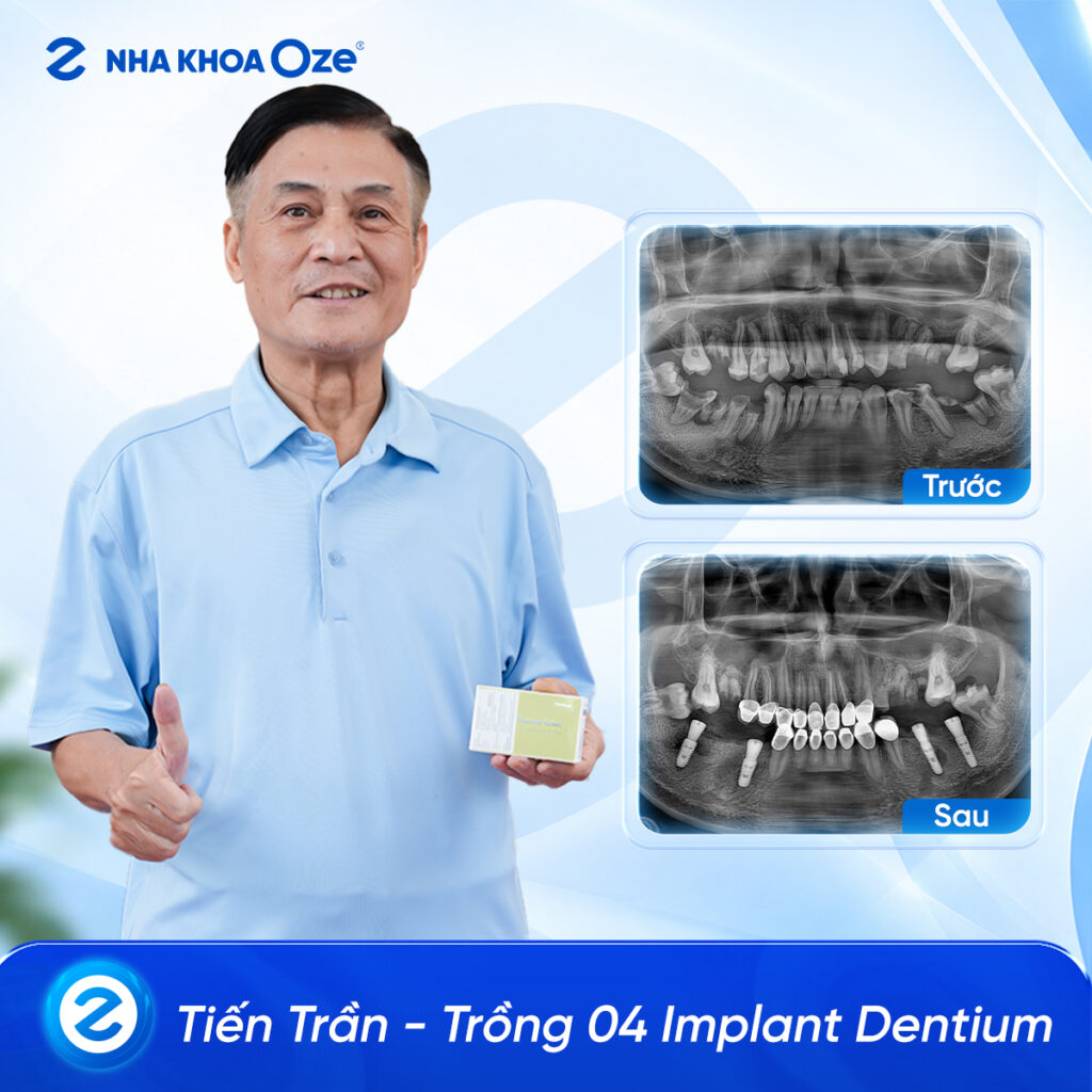 Feedback Implant 4