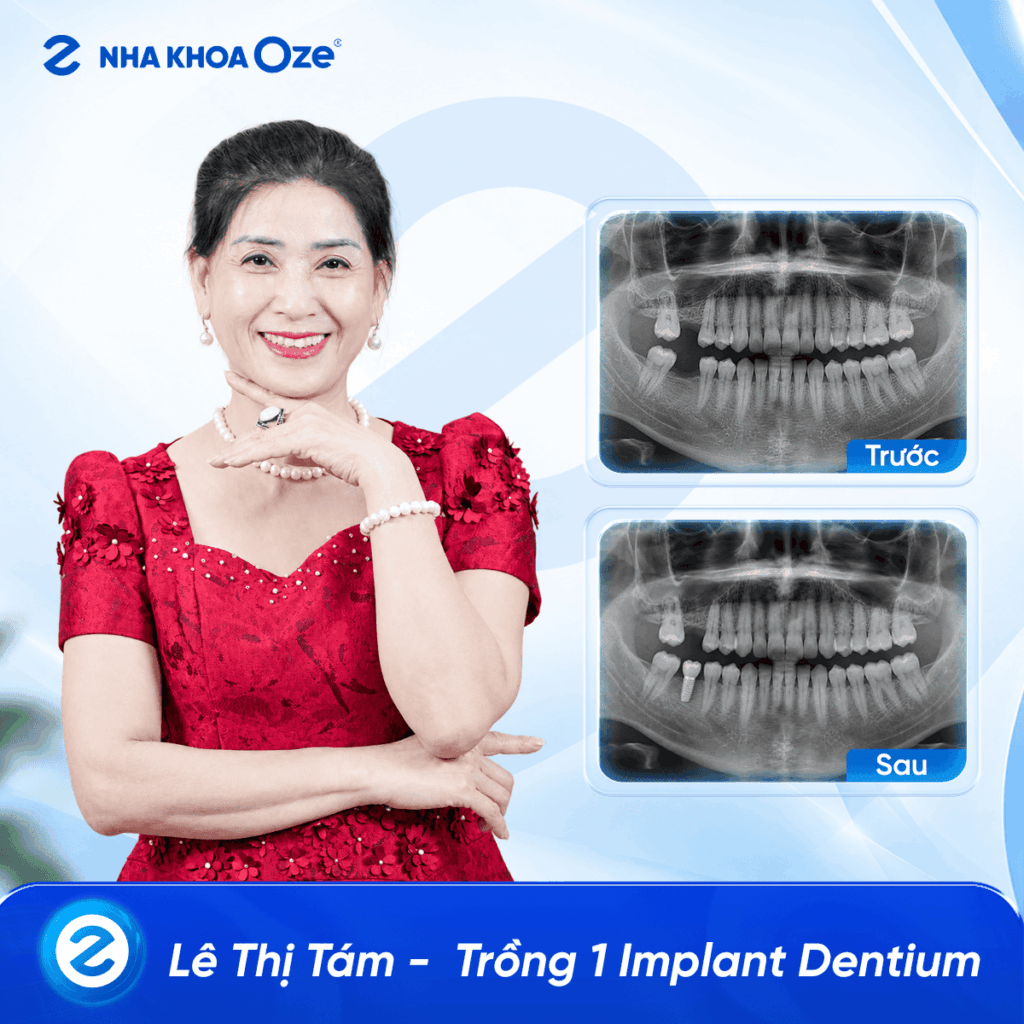 Feedback Implant 1