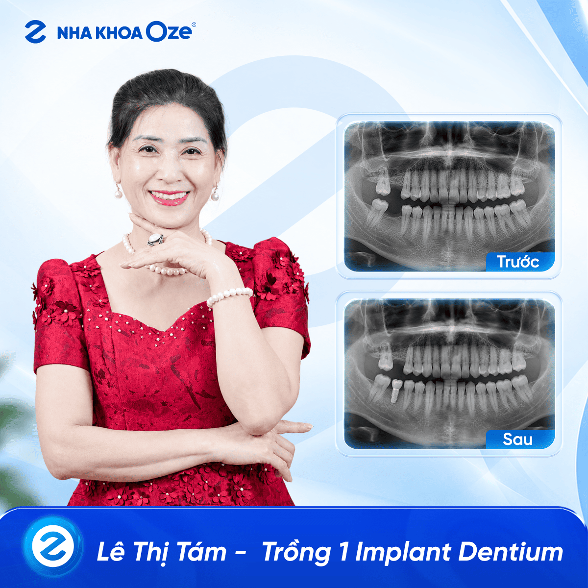 Khách hàng trồng răng implant