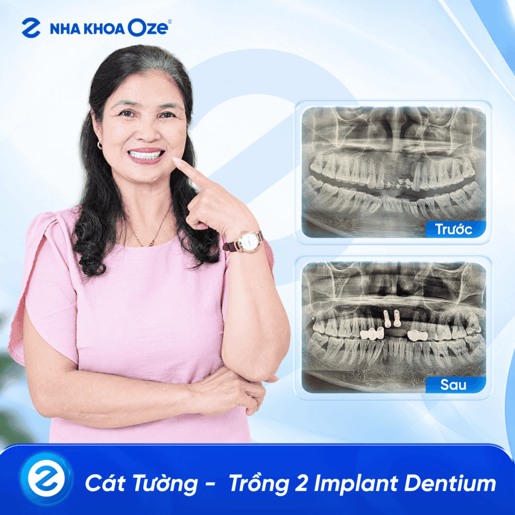 Feedback Implant 5