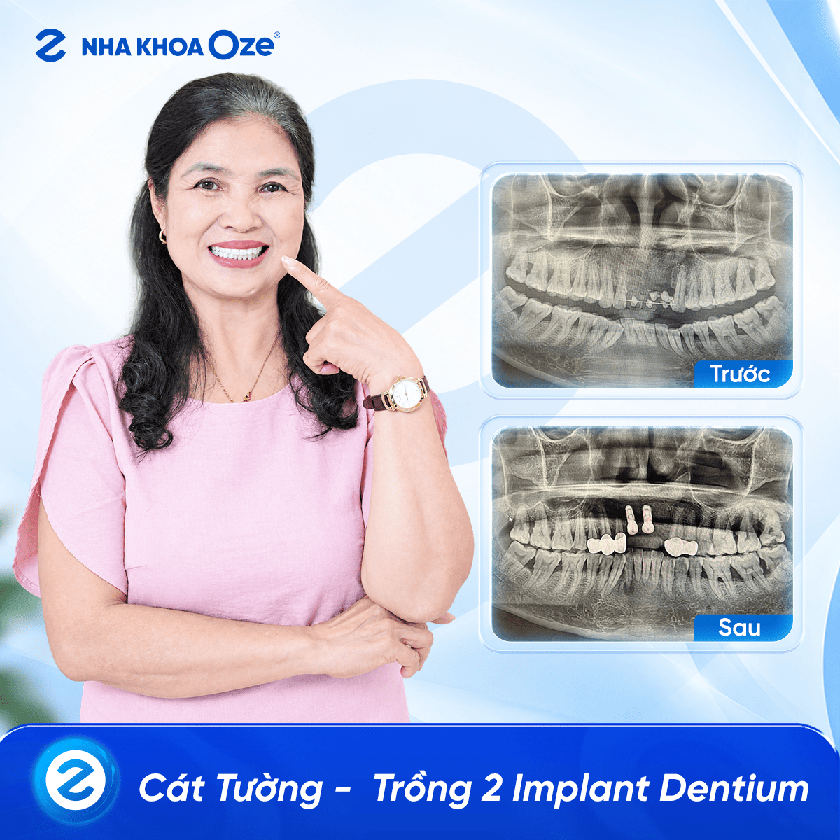 Khách hàng trồng răng implant