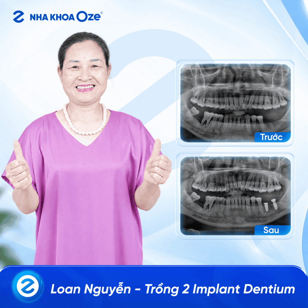 Feedback Implant 2