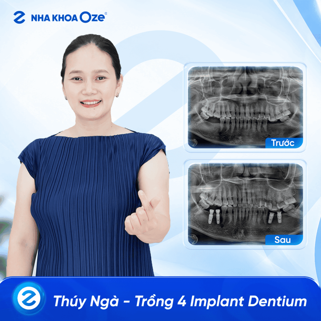Feedback Implant 3