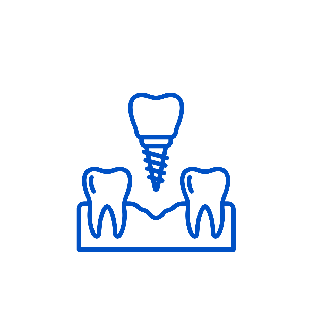 Tiến hành Cấy ghép trụ Implant