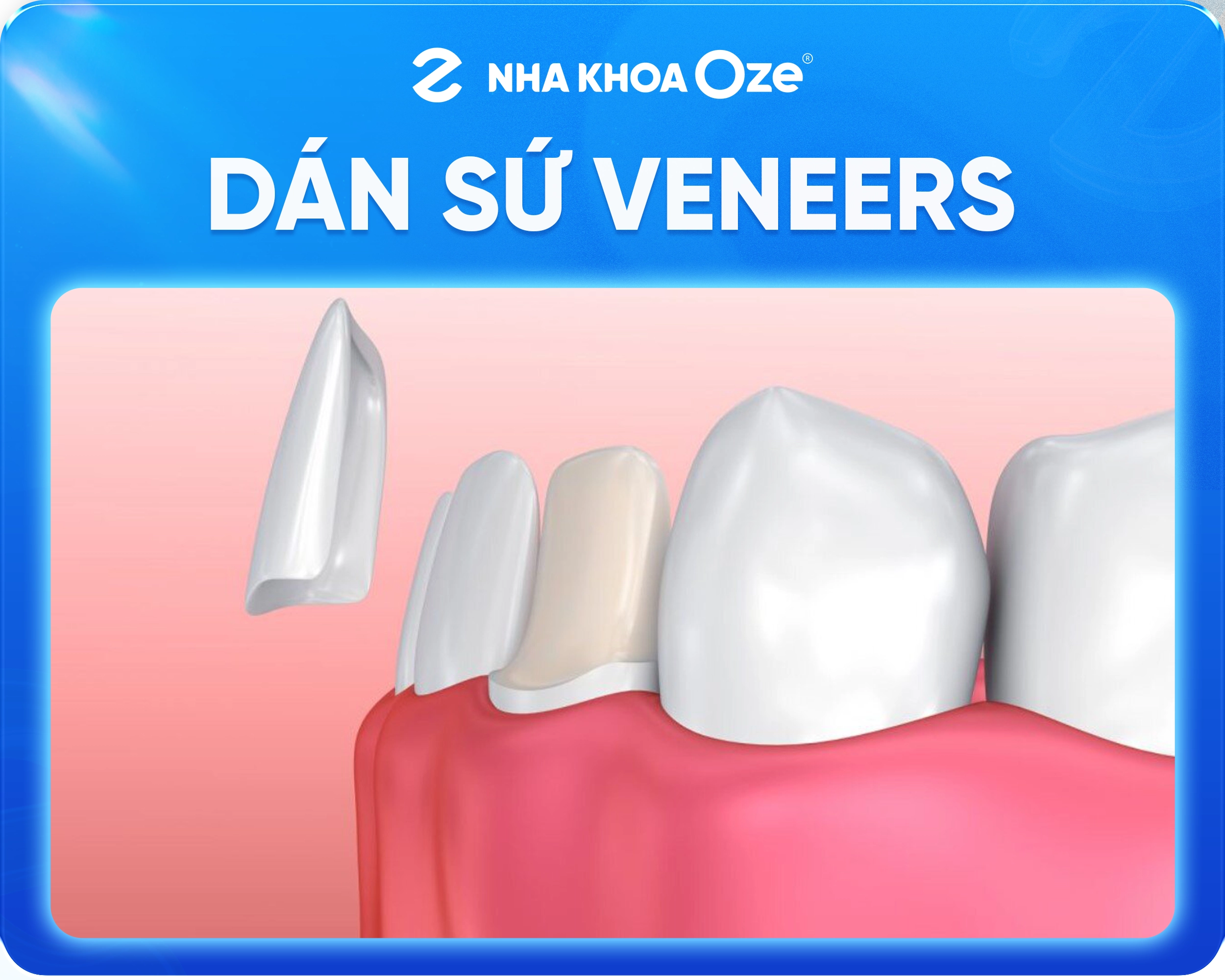Dán sứ Veneer