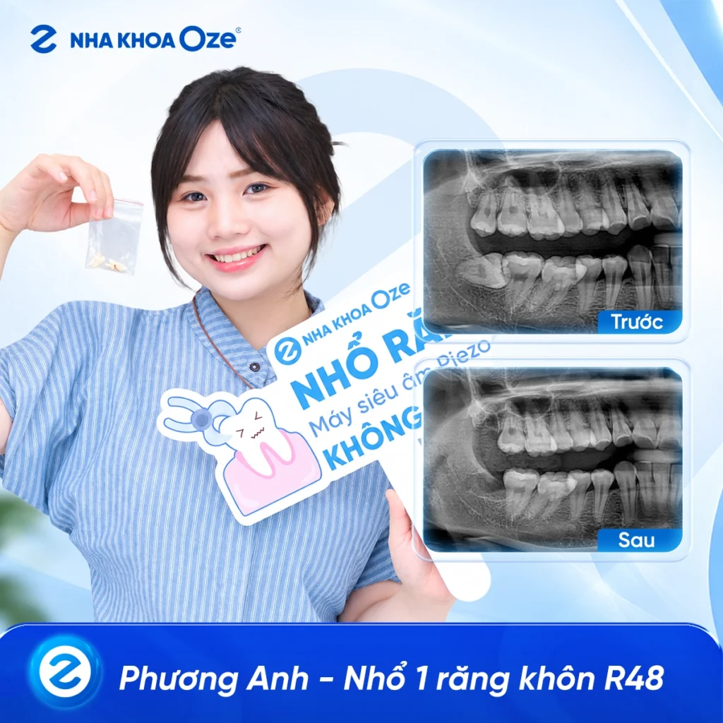 Feedback Nhổ Răng Khôn 1
