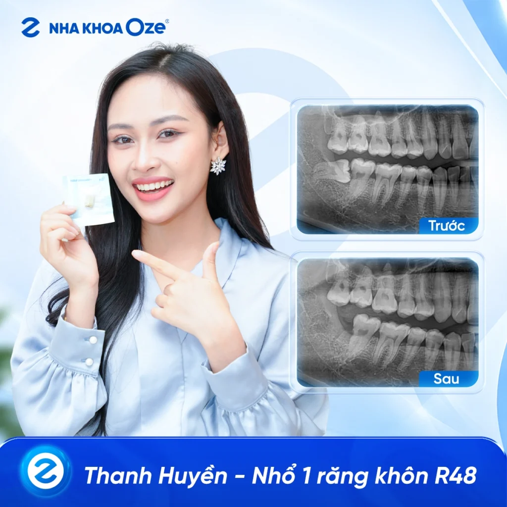 Feedback Nhổ Răng Khôn 2