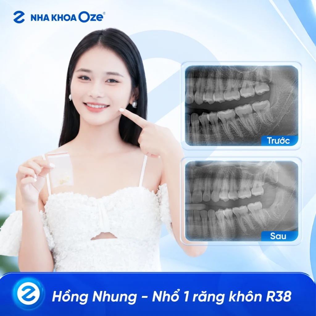 Feedback Nhổ Răng Khôn 4