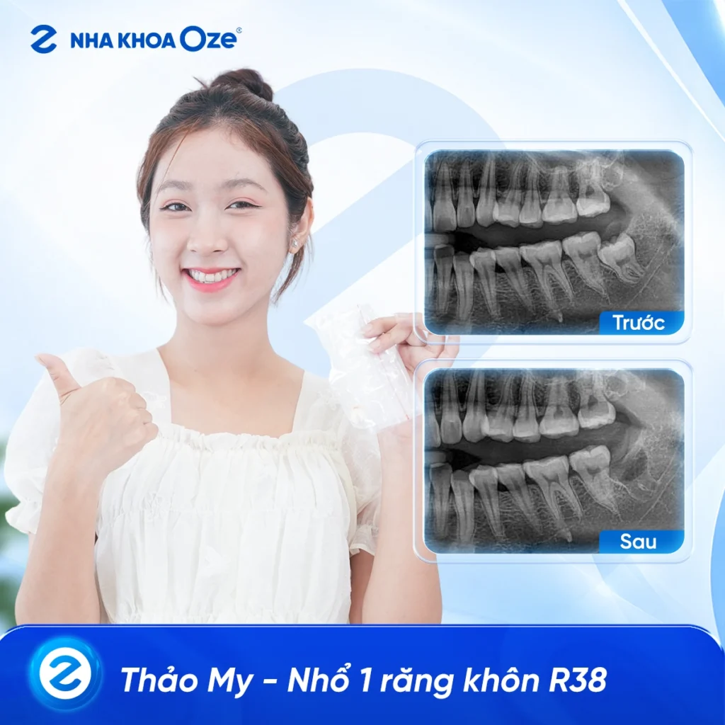 Feedback Nhổ Răng Khôn 3
