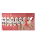 Các phương pháp niềng răng