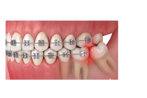 Các phương pháp niềng răng