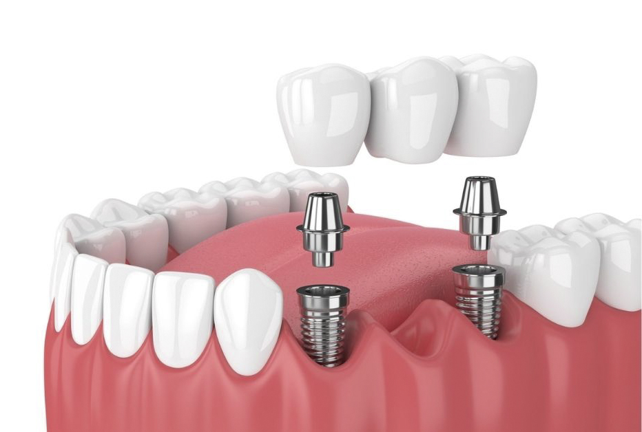 PHỤC HÌNH 1 VÀI RĂNG LIỀN KỀ