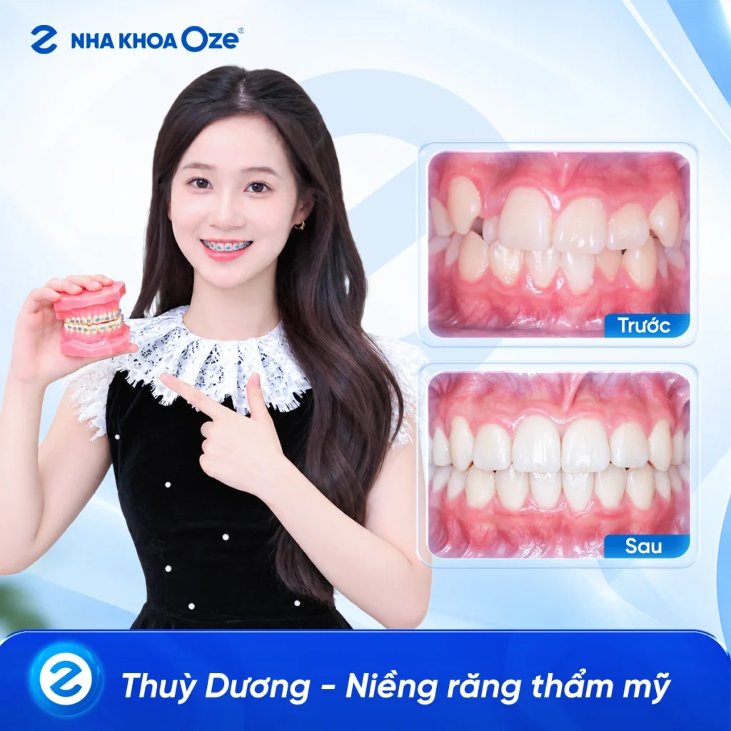 Feedback Niềng Răng 1