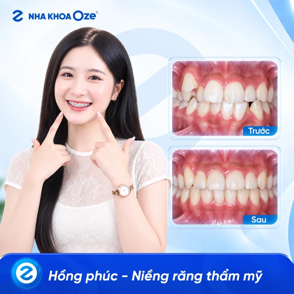 Feedback Niềng Răng 2