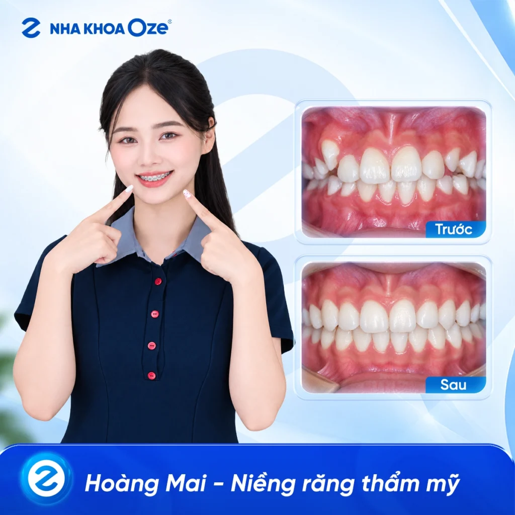 Feedback Niềng Răng 3
